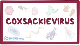 Coxsackievirus – causes, symptoms, diagnosis, treatment, pathology