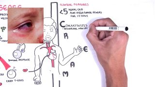 Kawasaki Disease vasculitis – symptoms,  pathophysiology, treatment