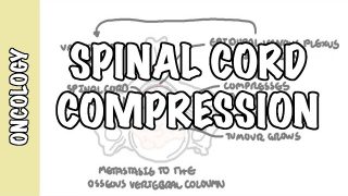 Spinal Cord Compression –  medical emergency, causes, symptoms, diagnosis, treatment