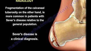 Sever’s Disease – Everything You Need To Know – Dr. Nabil Ebraheim