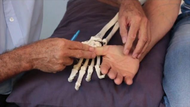 Treating Trigger Points – Thenar Eminence