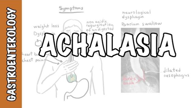 Achalasia (esophageal) – signs and symptoms, pathophysiology, investigations and treatment