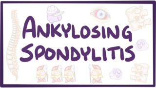 Ankylosing spondylitis – causes, symptoms, diagnosis, treatment, pathology