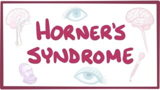 Horner’s syndrome – causes, symptoms, diagnosis, treatment, pathology