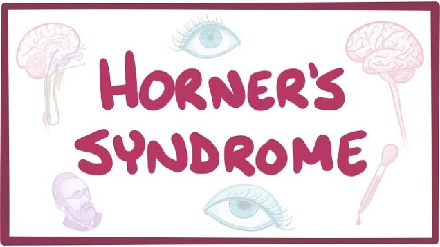 Horner’s syndrome – causes, symptoms, diagnosis, treatment, pathology
