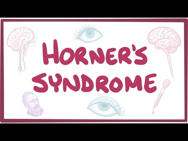 Horner's Syndrome - Causes, Symptoms, Diagnosis, Treatment, Pathology ...