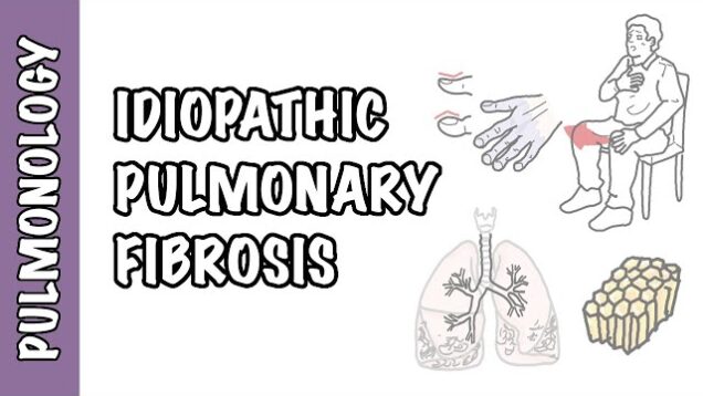 Idiopathic Pulmonary Fibrosis – pathophysiology, signs and symptoms, investigation and treatment