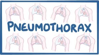 Pneumothorax – causes, symptoms, diagnosis, treatment, pathology