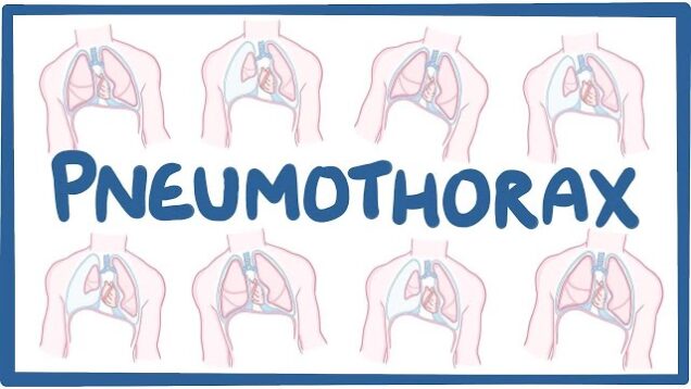 Pneumothorax – causes, symptoms, diagnosis, treatment, pathology
