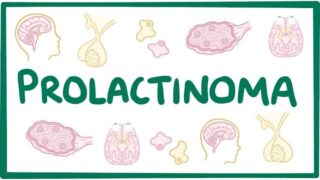 Prolactinoma – causes, symptoms, diagnosis, treatment, pathology