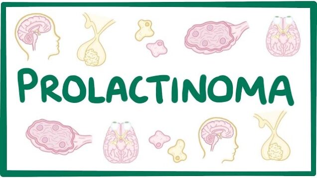 Prolactinoma – causes, symptoms, diagnosis, treatment, pathology
