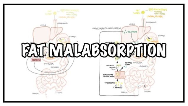 Approach to Fat malabsorption – signs and symptoms and causes