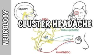 Cluster Headaches – symptoms, pathophysiology, treatment