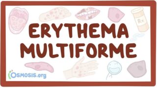 Erythema multiforme – causes, symptoms, diagnosis, treatment, pathology