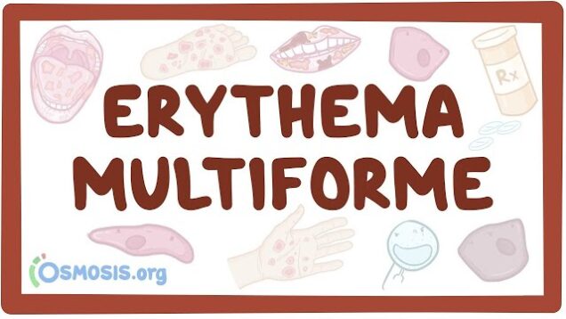 Erythema multiforme – causes, symptoms, diagnosis, treatment, pathology