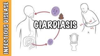 Giardiasis – Giardia Lamblia (Giardia intestinalis, Giardia duodenalis) infection