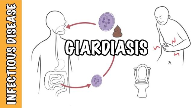 Giardiasis – Giardia Lamblia (Giardia intestinalis, Giardia duodenalis) infection