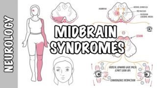 Midbrain Syndromes – Weber’s Syndrome, Benedikt’s Syndrome and Parinaud Syndrome.