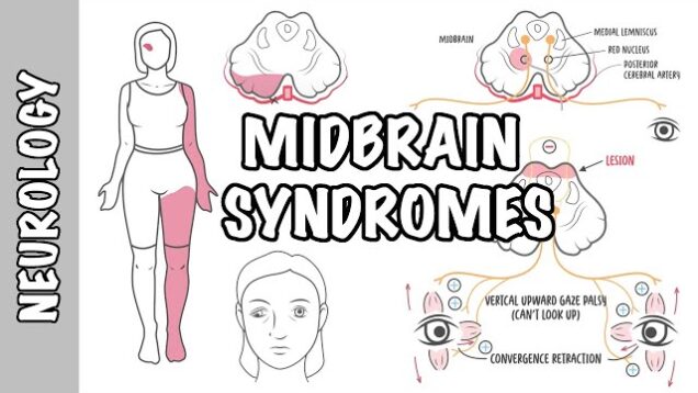 Midbrain Syndromes – Weber’s Syndrome, Benedikt’s Syndrome and Parinaud Syndrome.