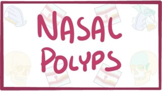 Nasal Polyps – causes, symptoms, diagnosis, treatment, pathology