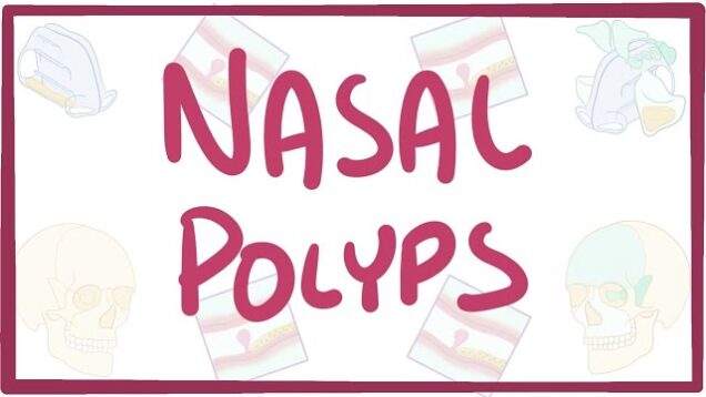 Nasal Polyps – causes, symptoms, diagnosis, treatment, pathology