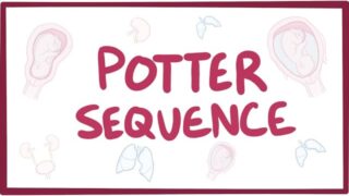 Potter sequence (oligohydramnios) – causes, symptoms, diagnosis, treatment, pathology