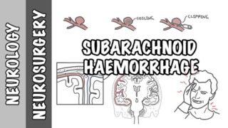 Subarachnoid Haemorrhage / pathophysiology, complications and management