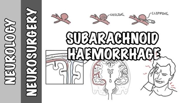 Subarachnoid Haemorrhage / pathophysiology, complications and management