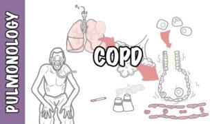 Understanding COPD – Chronic obstructive pulmonary disease cause, pathophysiology and treatment