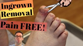 2nd Toe Pre-Dislocation Syndrome *Home Treatment*