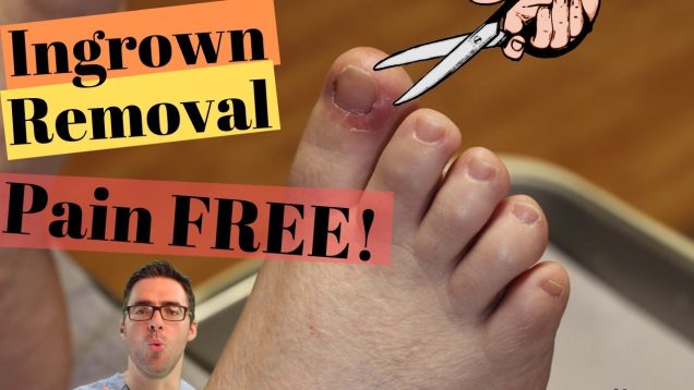 2nd Toe Pre-Dislocation Syndrome *Home Treatment*